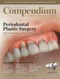 Restoration of Lost Interdental Papilla: A Surgical Technique by Peter Nordland D.M.D.