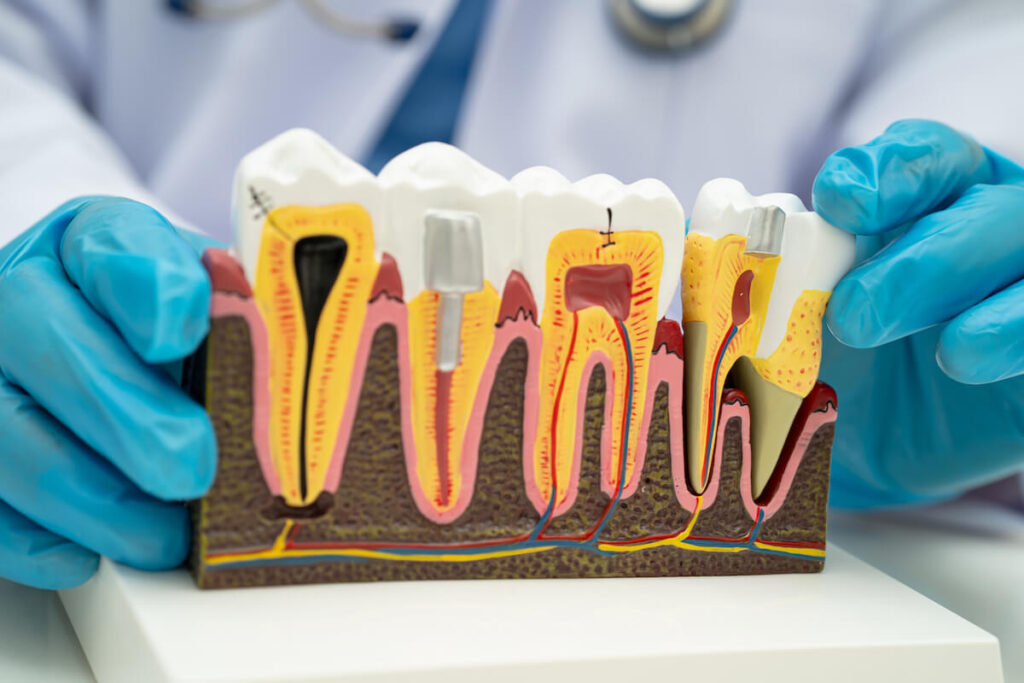 Dentist holding dental implant model