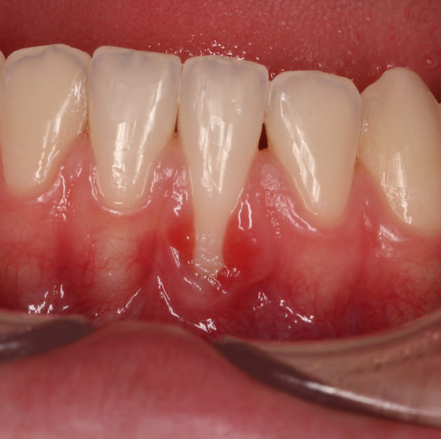 Before treatment showing gum recession with exposed roots and tissue irritation in a young patient