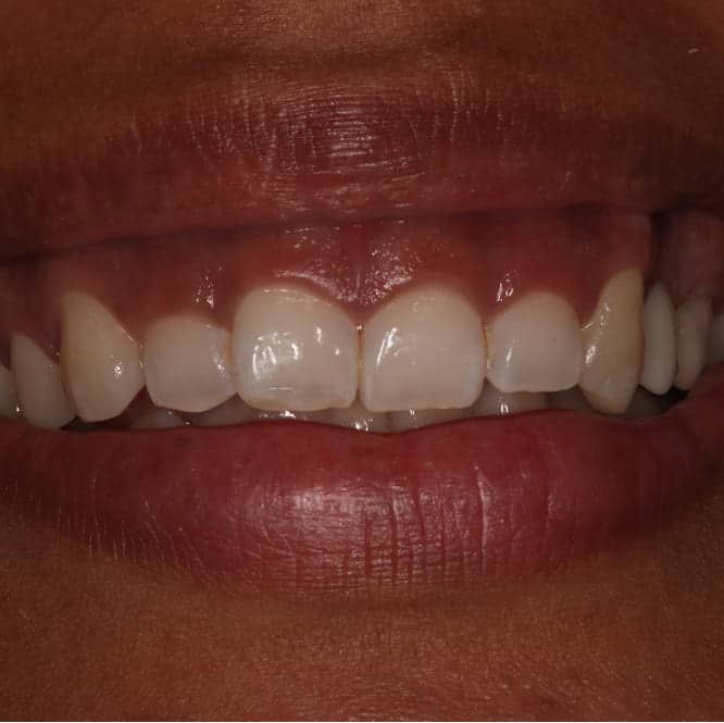 Before treatment showing excessive gingival display when smiling