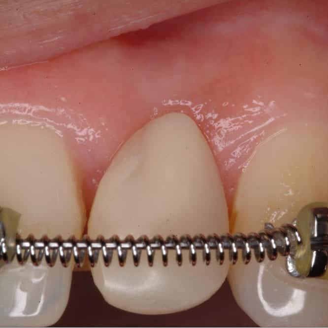 Before treatment image showing congenitally missing lateral incisor restored with a removable flipper