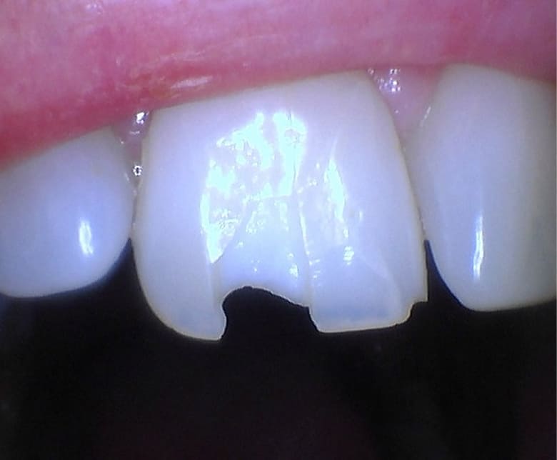 Before treatment showing discolored, fractured upper front tooth with visible root canal post