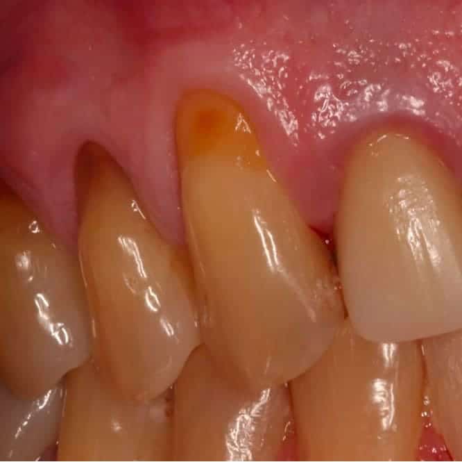 Before treatment showing severe gum recession with exposed and demineralized root surfaces on multiple teeth