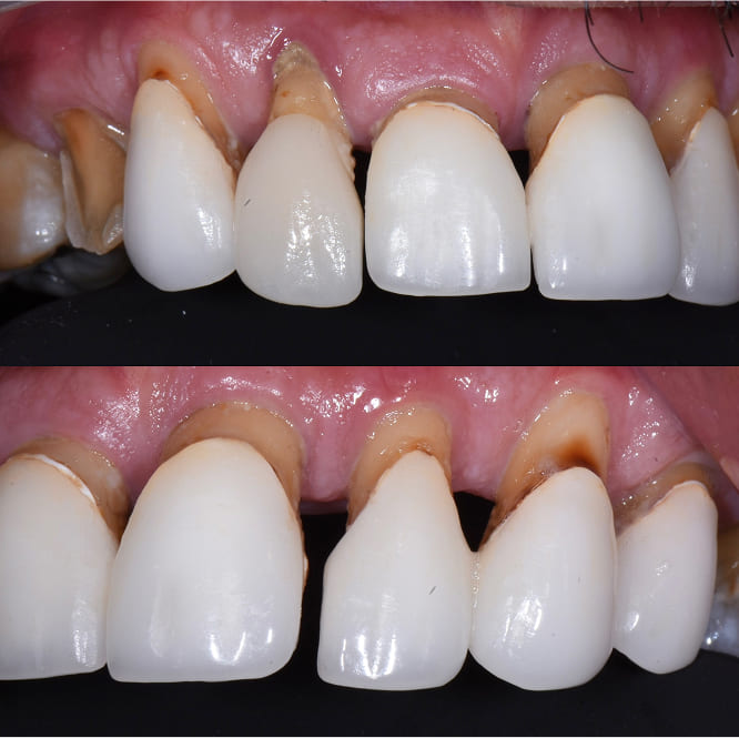 Before treatment showing advanced periodontal disease with mobile, failing teeth and significant bone loss