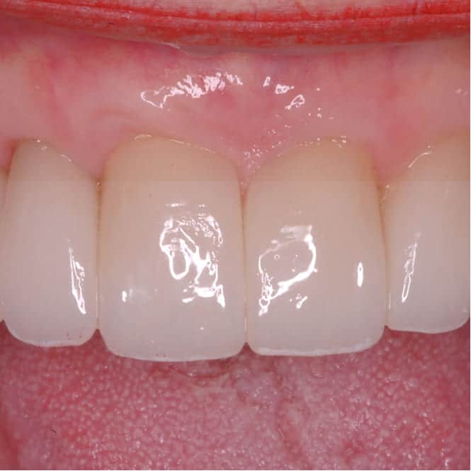 After treatment showing restored periodontal health with even gum contours and improved smile aesthetics