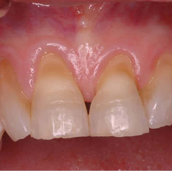 Before treatment showing worn, damaged teeth with irregular gum contours and compromised periodontal health