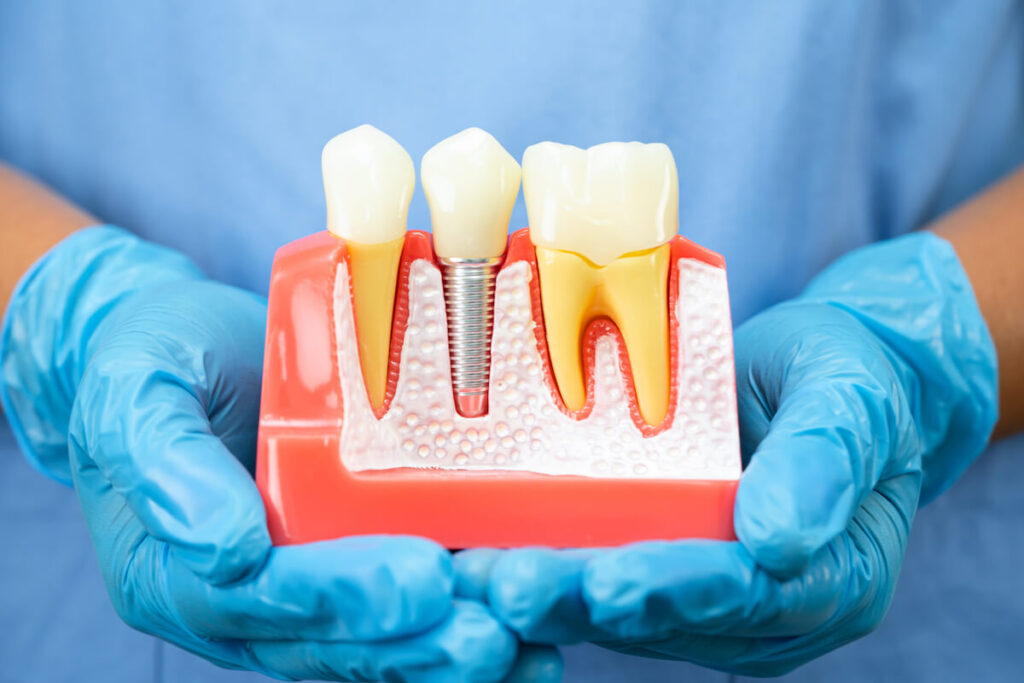 Dentist holding dental implant artificial - Oral Plastic Surgery & Periodontics