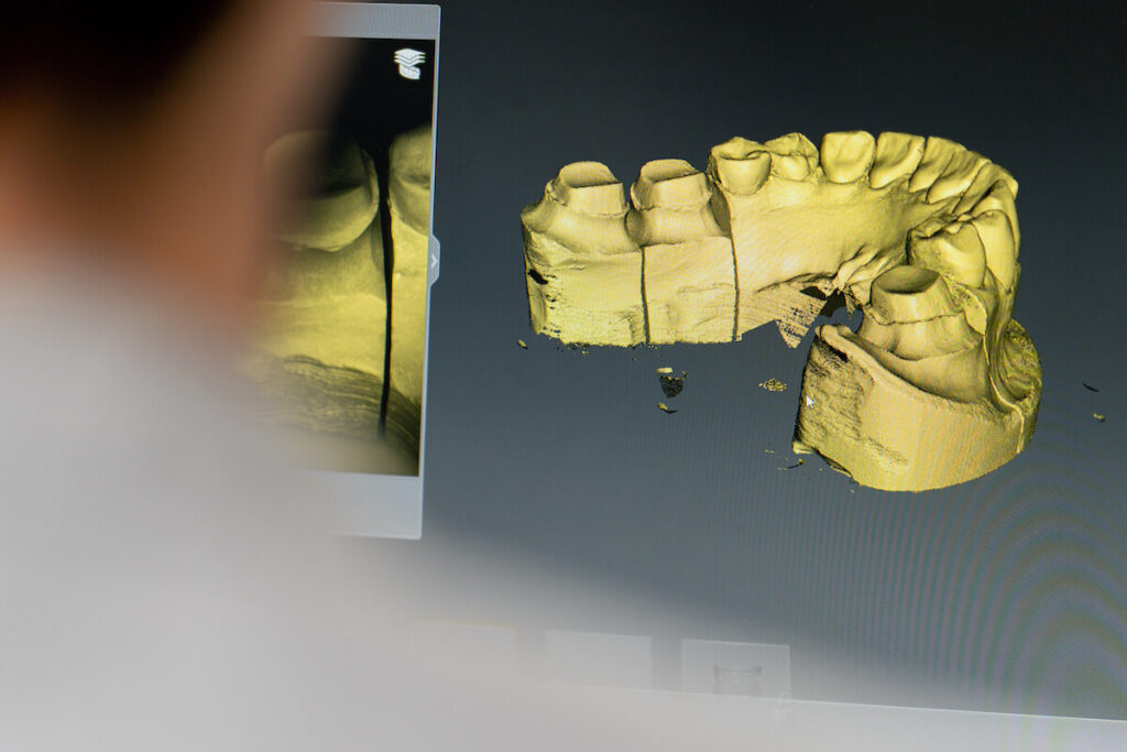 The role of osteoporosis and systemic health in bone loss - Oral Plastic Surgery & Periodontics