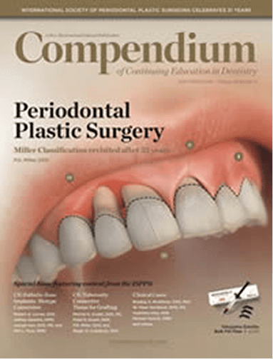Restoration of Lost Interdental Papilla: A Surgical Technique