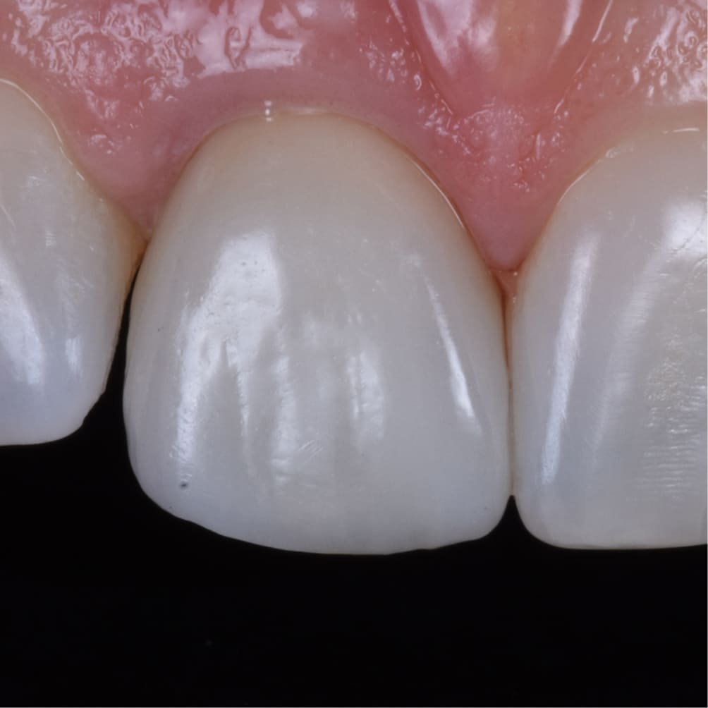 Restoring a Fractured Tooth with a Natural, Seamless Implant After
