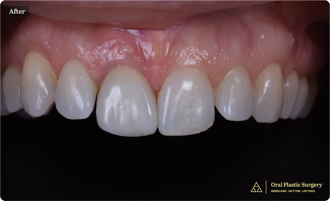 Showing the completed restoration with a natural and seamless appearance