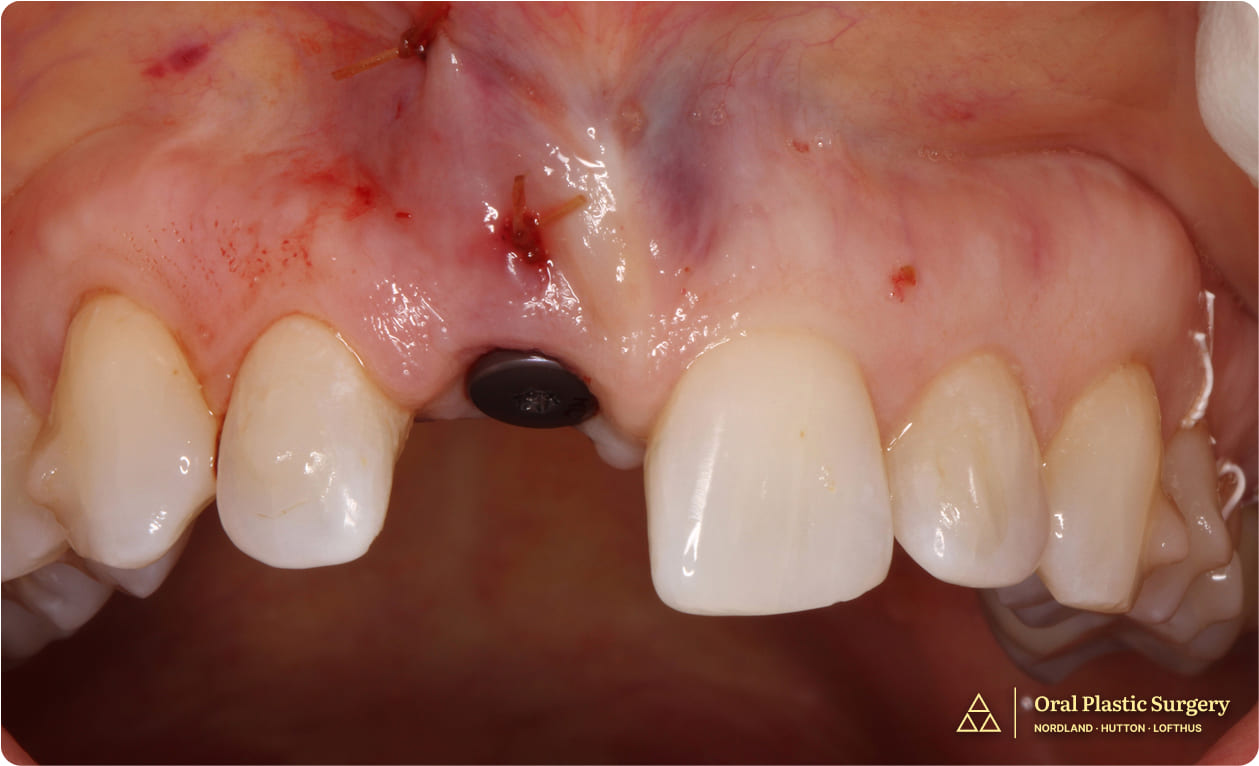 The implant was uncovered, a healing abutment was placed, and a ridge augmentation was performed to improve the gingiva contour