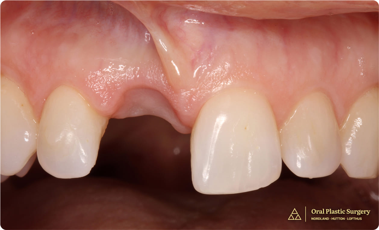 The ovate pontic on the Essix retainer helped shape the gum tissue, creating a natural-looking emergence profile