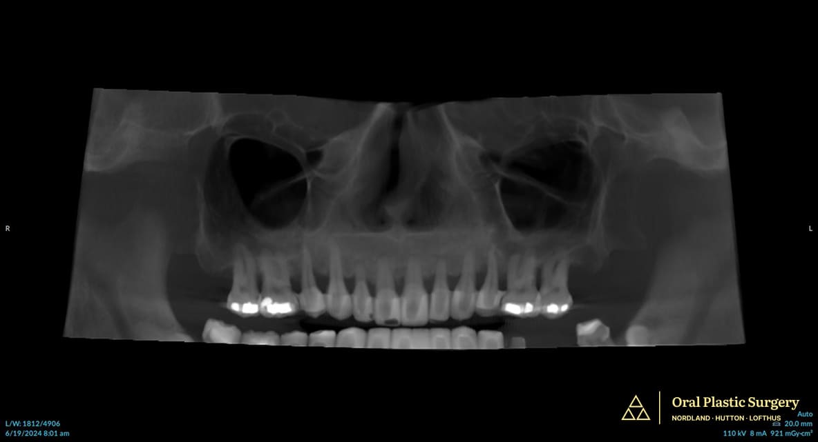 Before surgery- advanced periodontal disease and bone loss made saving the teeth impossible. Full-arch implant treatment was the best long-term solution