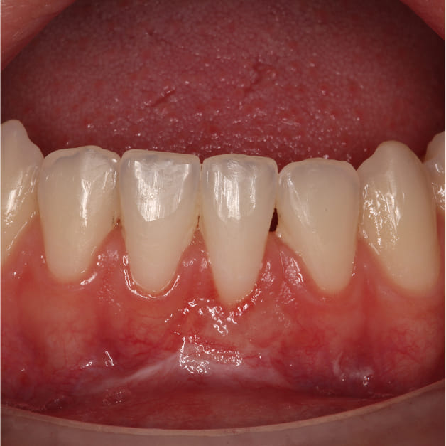 From Painful Sensitivity to a Healthy, Confident Smile After