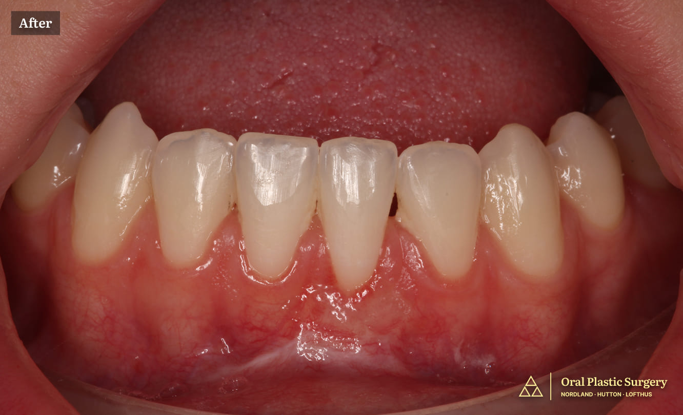 From Painful Sensitivity to a Healthy, Confident Smile After