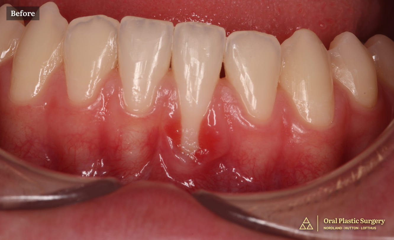 From Painful Sensitivity to a Healthy, Confident Smile Before