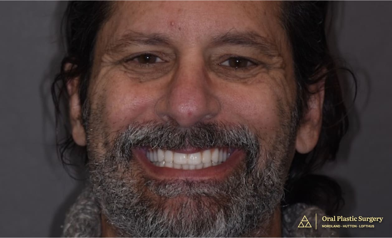 Restoring Health, Comfort, and Aesthetics by Eliminating Diseased Teeth Smiling Face