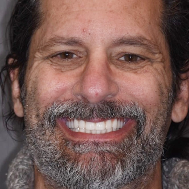 Restoring Health, Comfort, and Aesthetics by Eliminating Diseased Teeth After