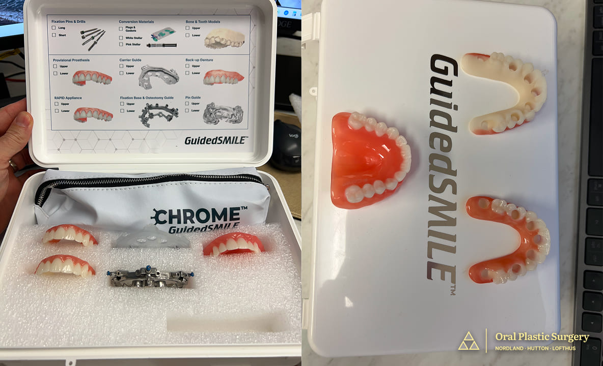 The GuidedSMILE system ensured accuracy and efficiency during surgery. Custom guides and provisional teeth allowed Phil to leave with a new smile the very same day