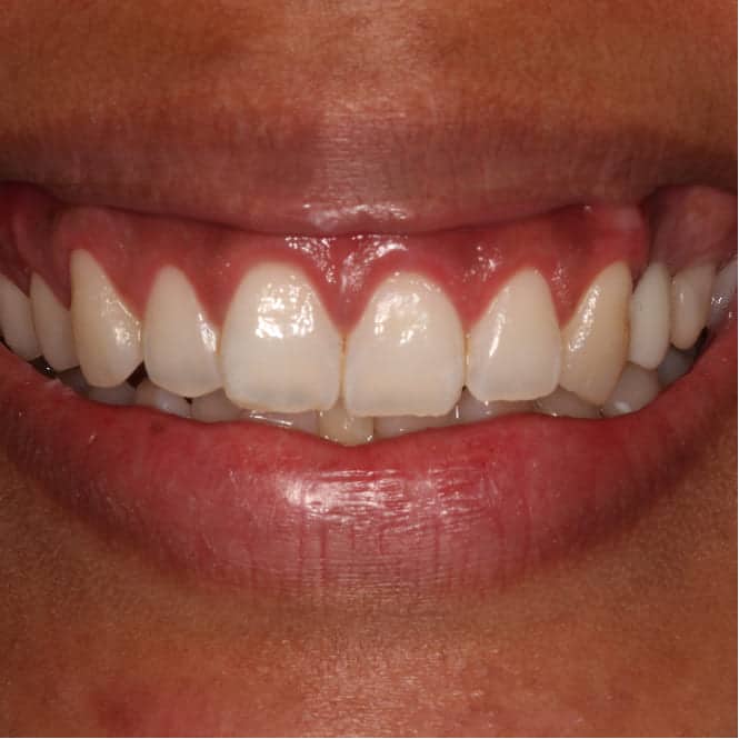 More natural tooth display and balanced gumline after single-visit smile makeover surgery. Teeth appear properly proportioned without any restorative work