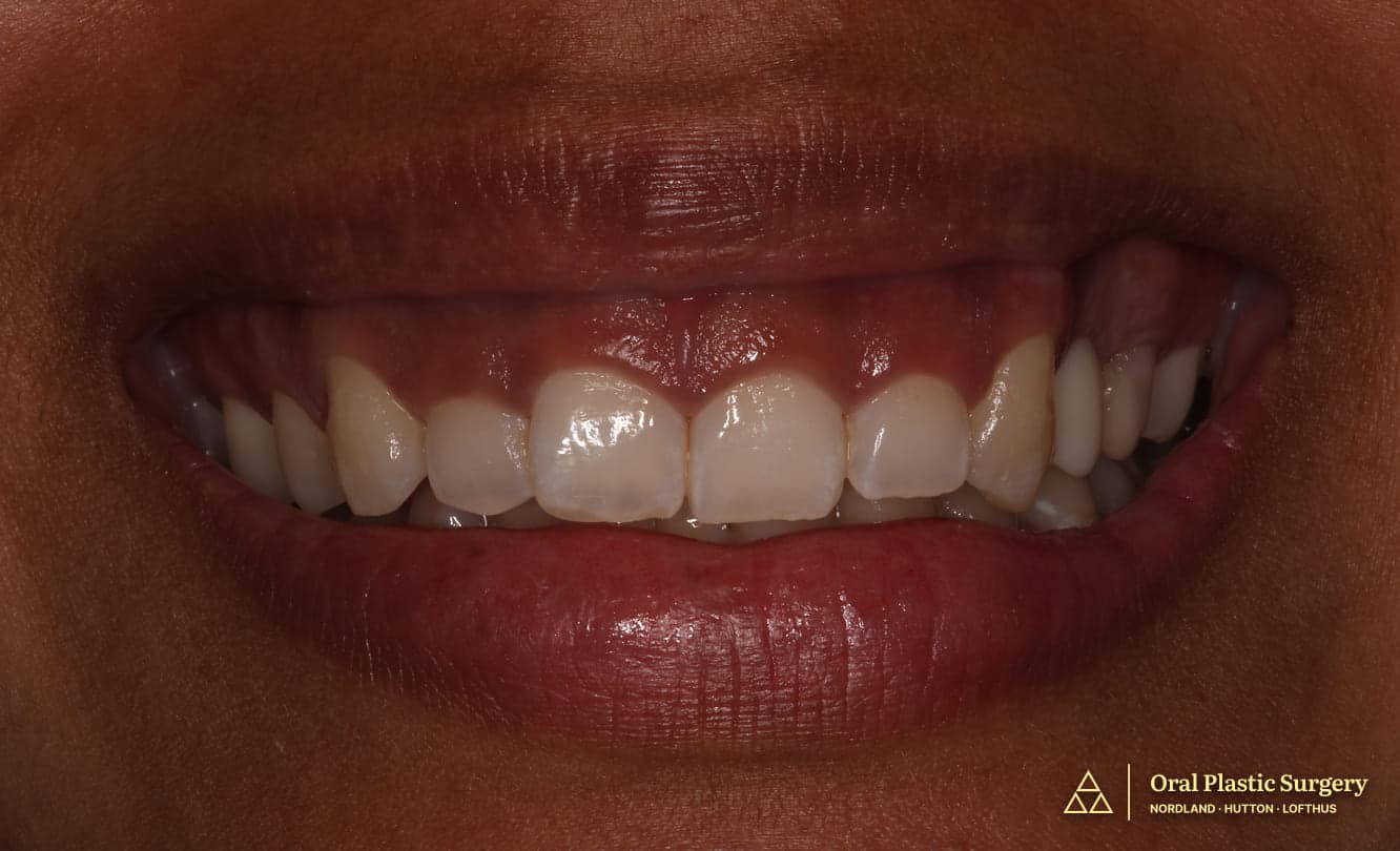 Excess gum display creating a "gummy smile" appearance. Note the short clinical crown length and disproportionate gum-to-tooth ratio