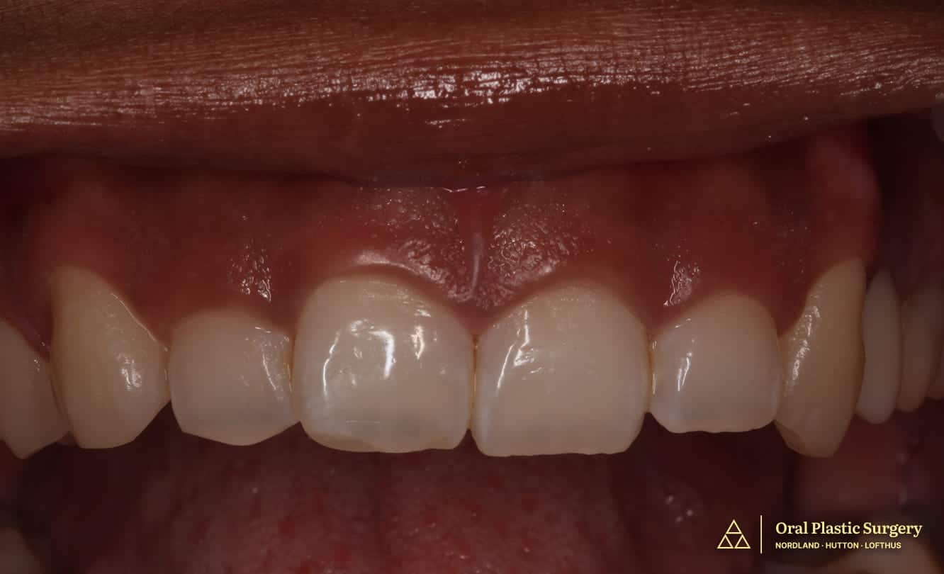 Short clinical crowns due to excess gingival coverage. Note the disproportionate gum tissue levels