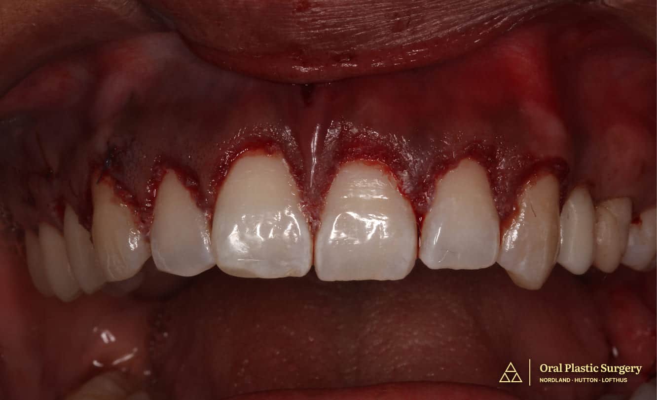 Improved tooth proportions and stable gingival symmetry after microsurgical crown lengthening, natural tooth structure revealed