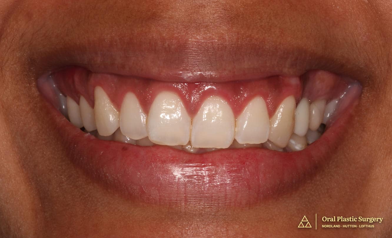 More natural tooth display and balanced gumline after single-visit smile makeover surgery. Teeth appear properly proportioned without any restorative work