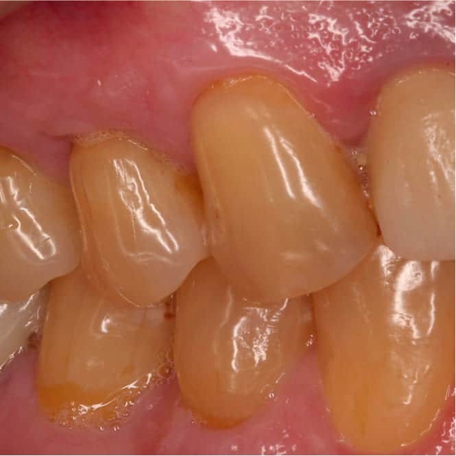 Severely Exposed, Demineralized Roots Restored in a Single Microsurgical Visit - After