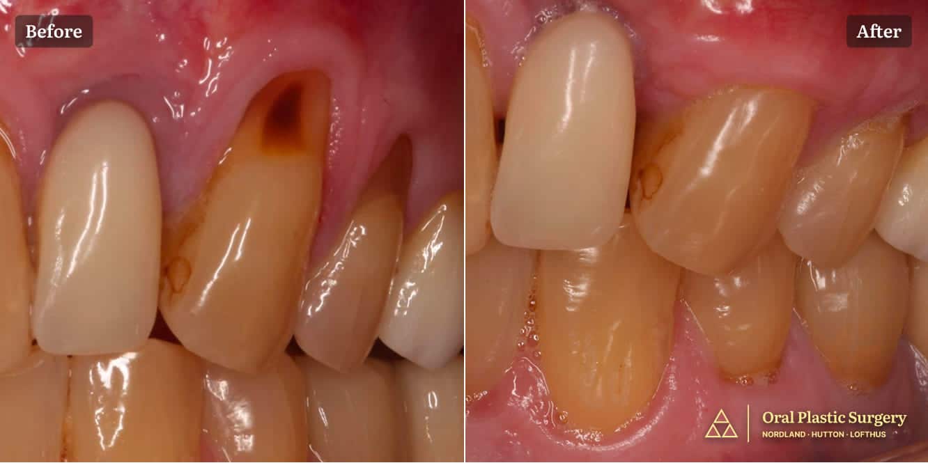 The before image shows recession affecting multiple teeth in the left quadrant, with visible root exposure The after image shows post-operative outcome demonstrating successful root coverage and increased width of keratinized tissue