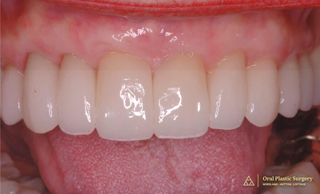 Final post-treatment results demonstrating seamless integration of restored gums and custom restorations following four-month comprehensive treatment.