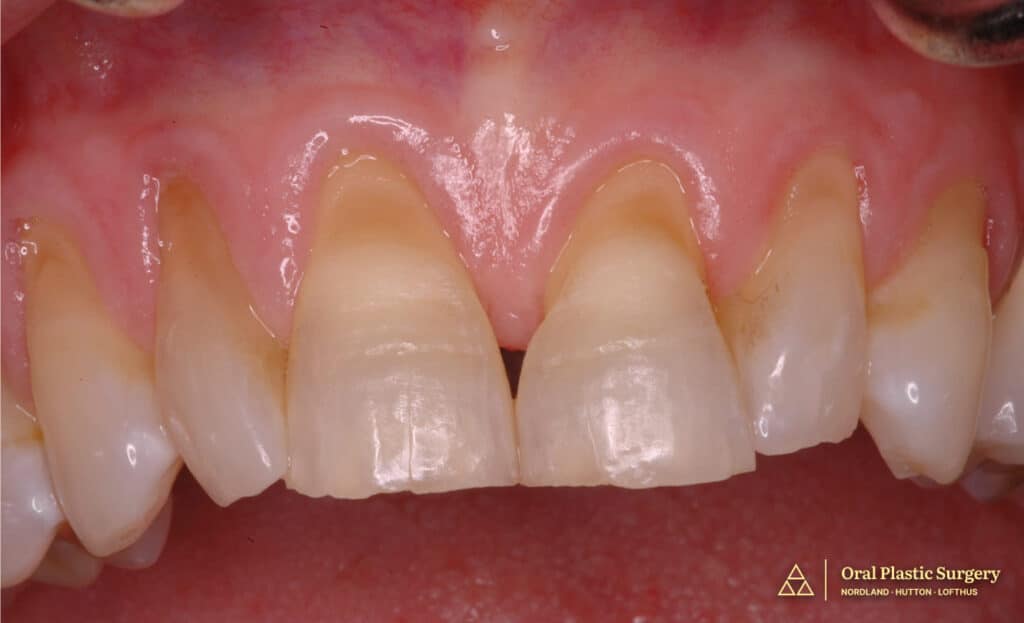 Initial presentation showing exposed, worn, and discolored root surfaces with chipping and discoloration of maxillary anterior teeth.