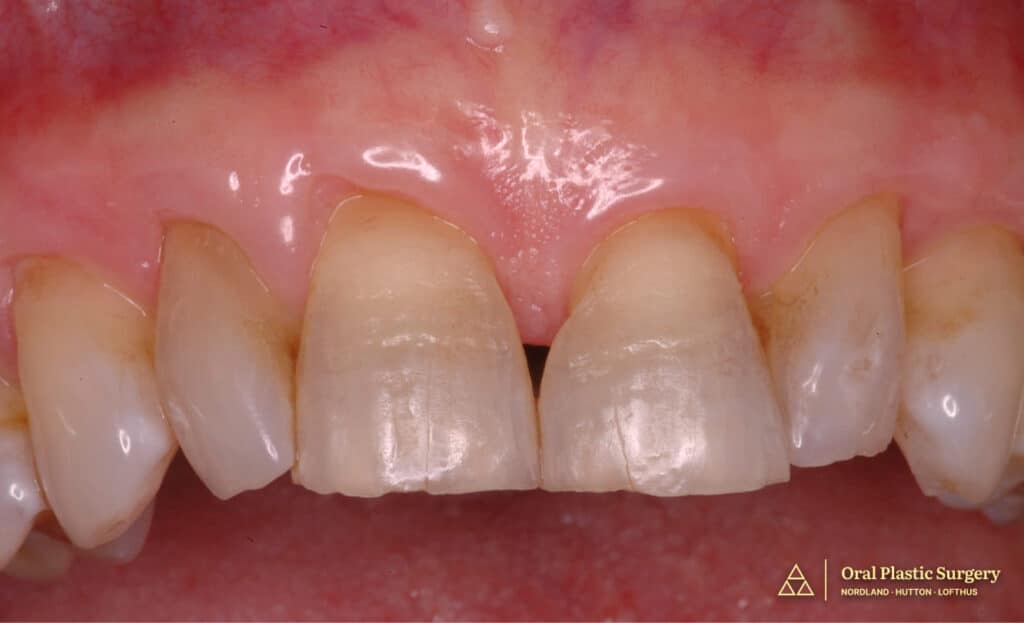Post connective tissue grafting showing dramatic improvement in root coverage, tissue color, and gingival contour prior to final restorative work.