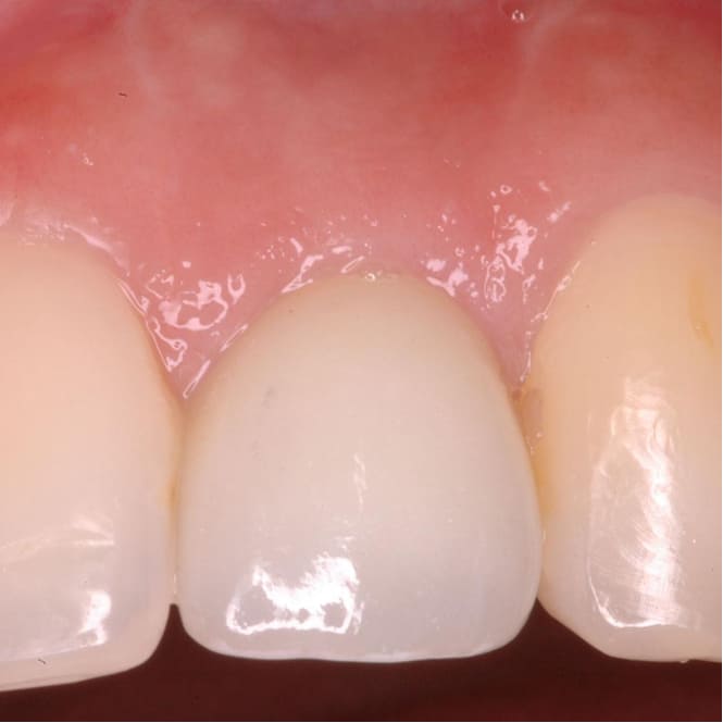 Post-treatment result showing the implant crown fully integrated with natural tooth proportions, gingival contours, and smile esthetics.