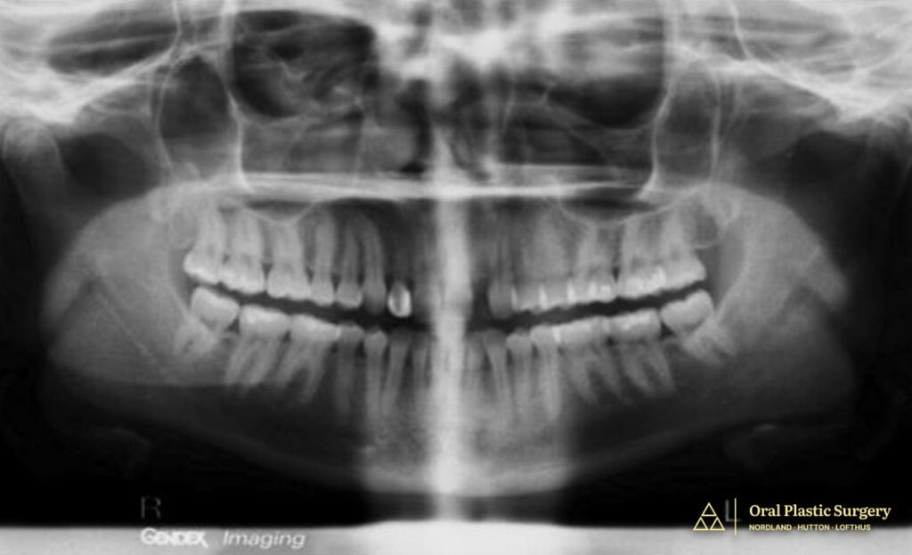Pre-treatment frontal view showing spacing maintained with a removable prosthesis. The ridge deficiency is evident clinically, confirming CBCT findings of inadequate bone width for implant placement.