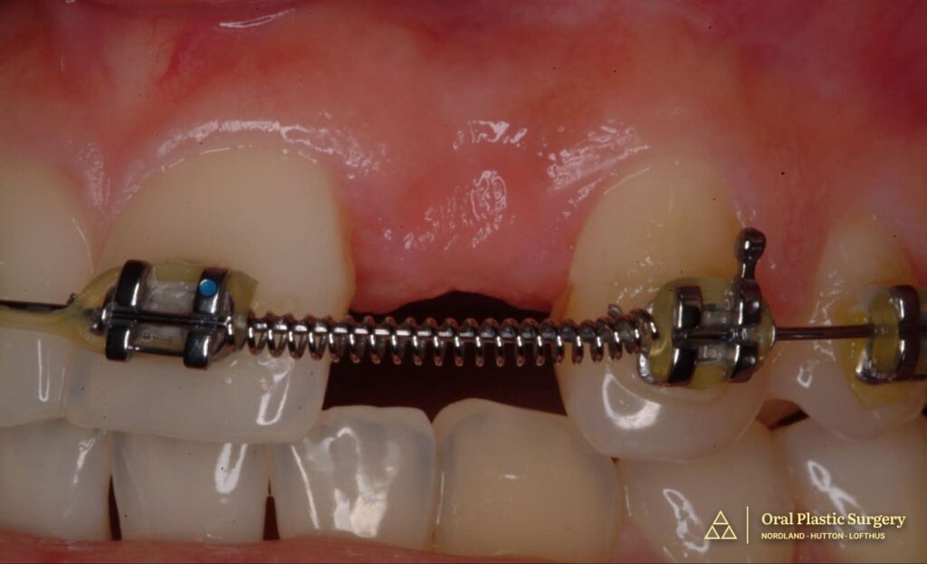 Active orthodontic treatment establishes ideal spacing and root angulation of adjacent teeth. Coordination between orthodontist and periodontist ensures optimal three-dimensional positioning for future implant placement.