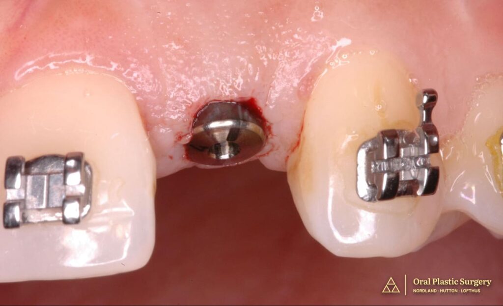 Following six months of bone block graft integration, the implant was positioned in the augmented ridge with ideal three-dimensional placement for long-term esthetic and functional success.