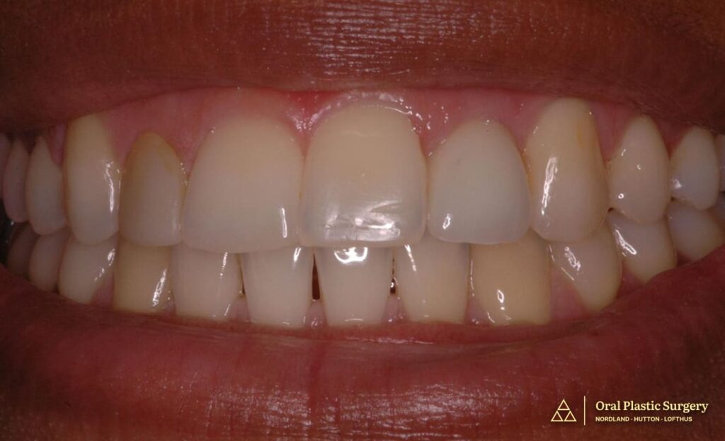 Final implant restoration demonstrating natural emergence profile, ideal tissue architecture, and symmetric integration with adjacent dentition. The result is indistinguishable from a natural tooth.